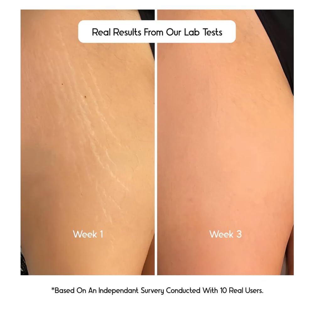 Cos-IQ Stretch Marks Removal Roll-On Serum with Striover | Scar Removal | Uneven Skin Tone | All Skin Types | 40ml
