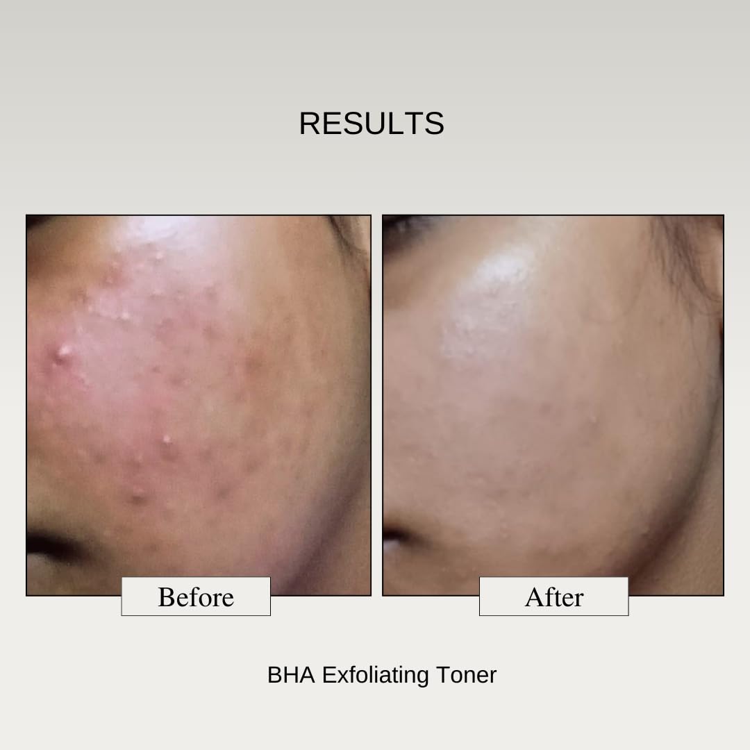 The Formularx 2% BHA Exfoliating Serum, 2% Salicylic Acid, and Niacinamide Face Serum for Acne Prone Skin and Blackheads,Suitable for Oily Skin, Beginner and Sensitive Skin Friendly, 100ml