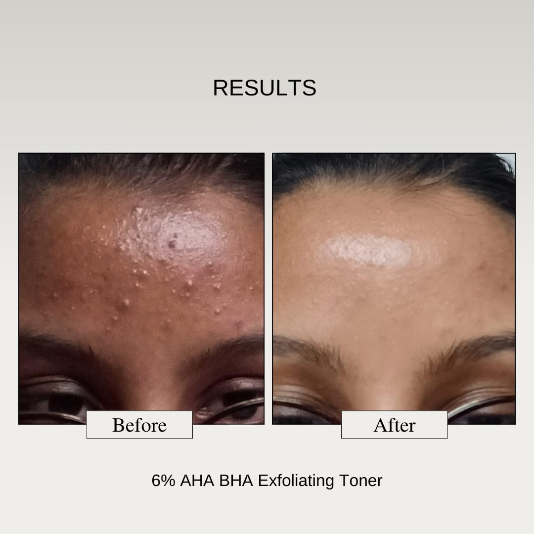 The Formularx 6% Aha Bha Exfoliator(5% Glycolic & 1% Salicylic Acid)Exfoliating Serum For Whiteheads,Enlarged Pores,Dark Spots|Brightens & Smoothens Texture|For Oily,Combo,Acne Prone Skin 100 Ml
