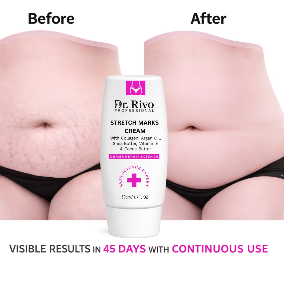 Dr. Rivo Professional Stretch Marks Cream for Women & Men | Pregnancy & Post Pregnancy Stretch Mark Care | Collagen, Shea Butter, Cocoa Butter & Vitamin E | Moisturizing Skin Repair Cream for Belly, Thighs & Hips | 50g
