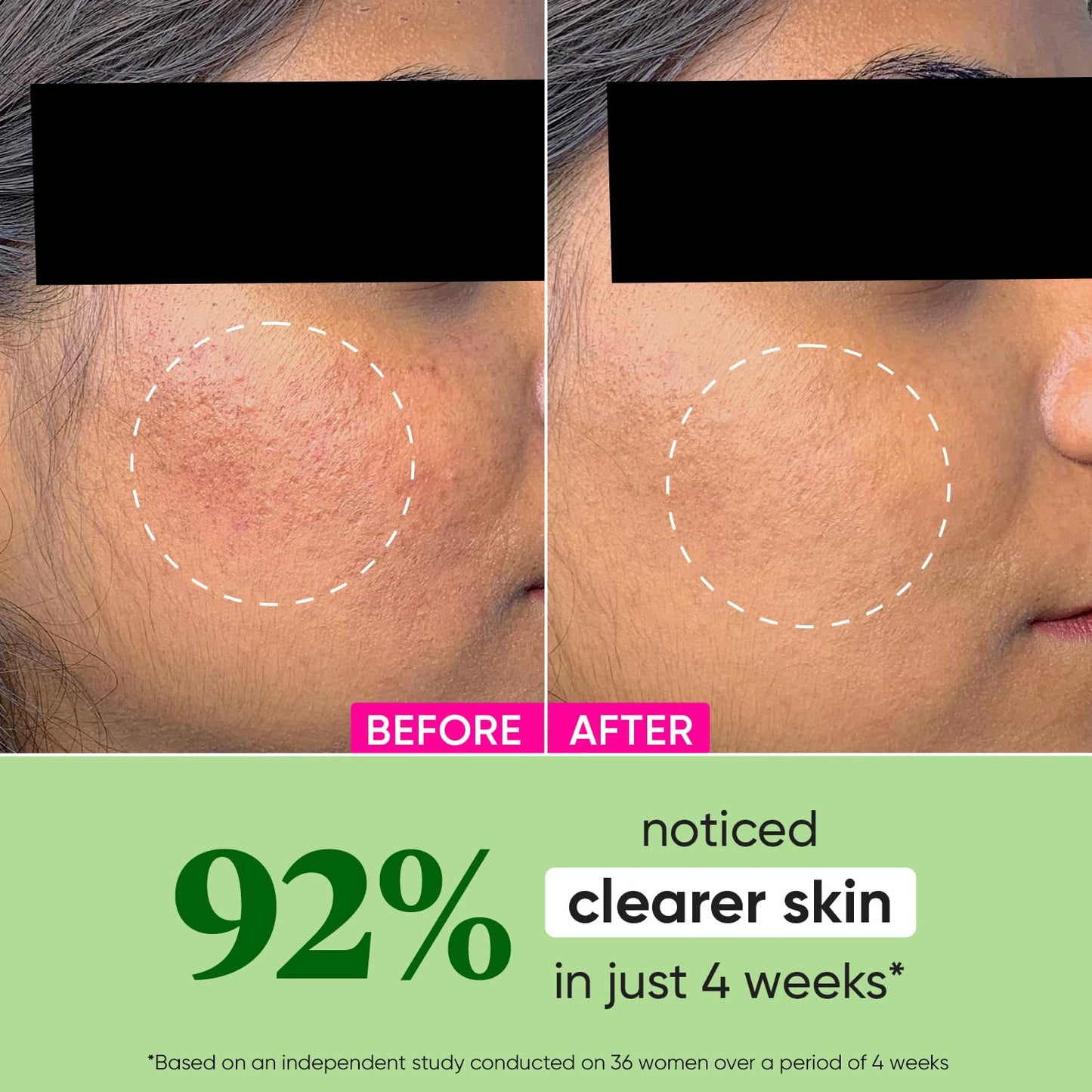 Zephivo DOT & KEY Cica + Niacinamide Oil Free Moisturizer For Acne Prone Skin Oil Free & Lightweight Fades Dark Spots & Blemishes, Soothes Redness Acne Cream For Oily Acne Prone & Sensitive Skin 50Gm