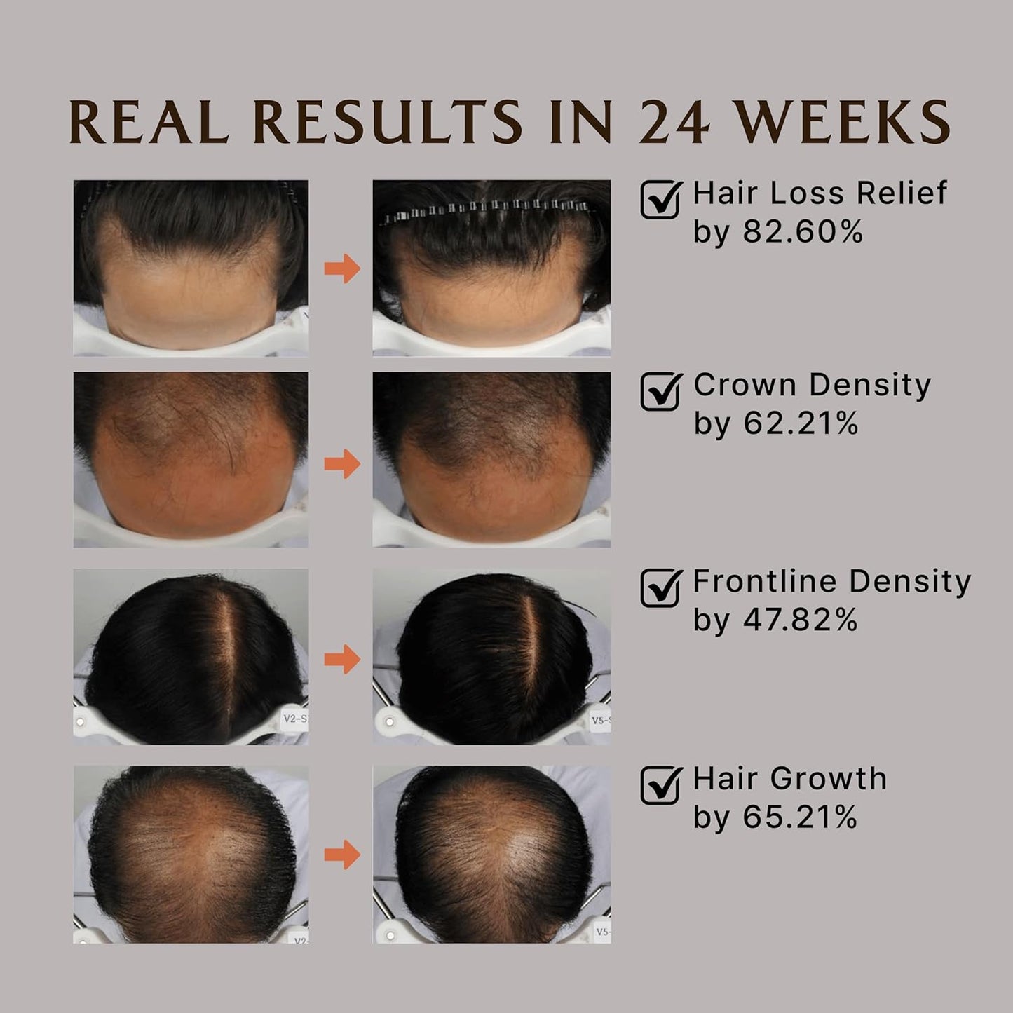 LADOR Dermatical Hair-Loss Treatment Conditioner (For Thin Hair) (200ml) Nourishing Strengthening Hair Mask Treatment, Hydrating Deep Conditioner for Dry Damaged Thinning Hairs, Korean Haircare