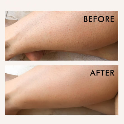 Before and after comparison of a person's leg with visible skin texture changes.