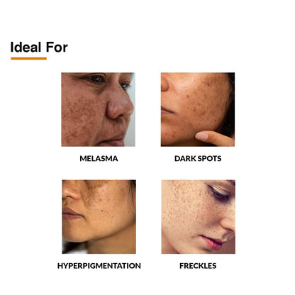 Fixderma 2% Kojic Acid + 1% Arbutin Skarfix-Plus Scar Removal Cream | Hyperpigmentation Removal Cream and Acne Scars Removal Cream | Helps to Reduce Melasma- 15 g