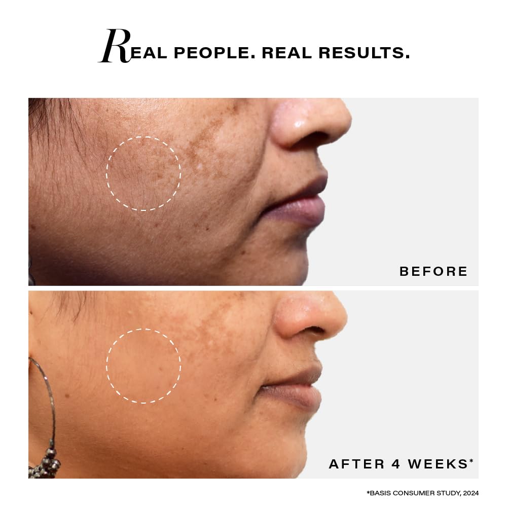 Before and after comparison of skin treatment on a person's face with text 'Real People. Real Results.'