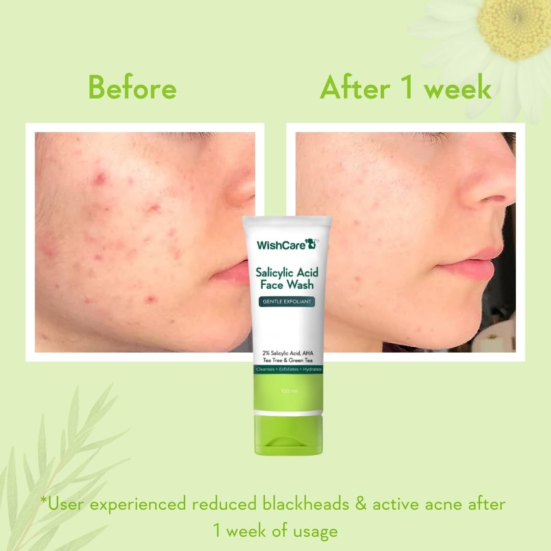 Before and after comparison of acne treatment with a tube of WishCare Salicylic Acid Face Wash.