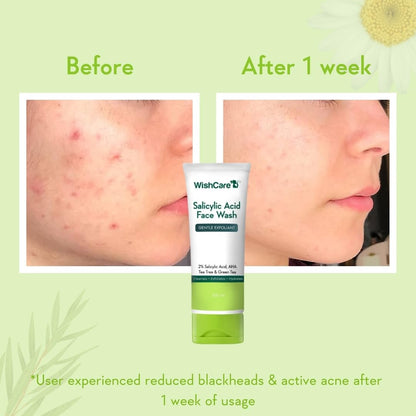 Before and after comparison of acne treatment with a tube of WishCare Salicylic Acid Face Wash.