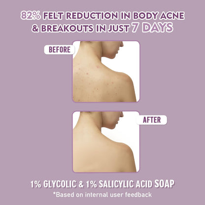 Glamveda Anti Acne 1% ww Glycolic Acid & 1% ww Salicylic Acid Soap | Reduces Dark Spots, Acne Scars & Hyperpigmentation - 75gm Pack of 1