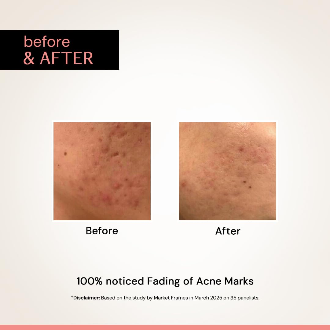 Before and after comparison of acne marks on skin with text indicating 100% noticed fading.