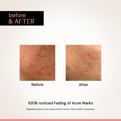 Before and after comparison of acne marks on skin with text indicating 100% noticed fading.
