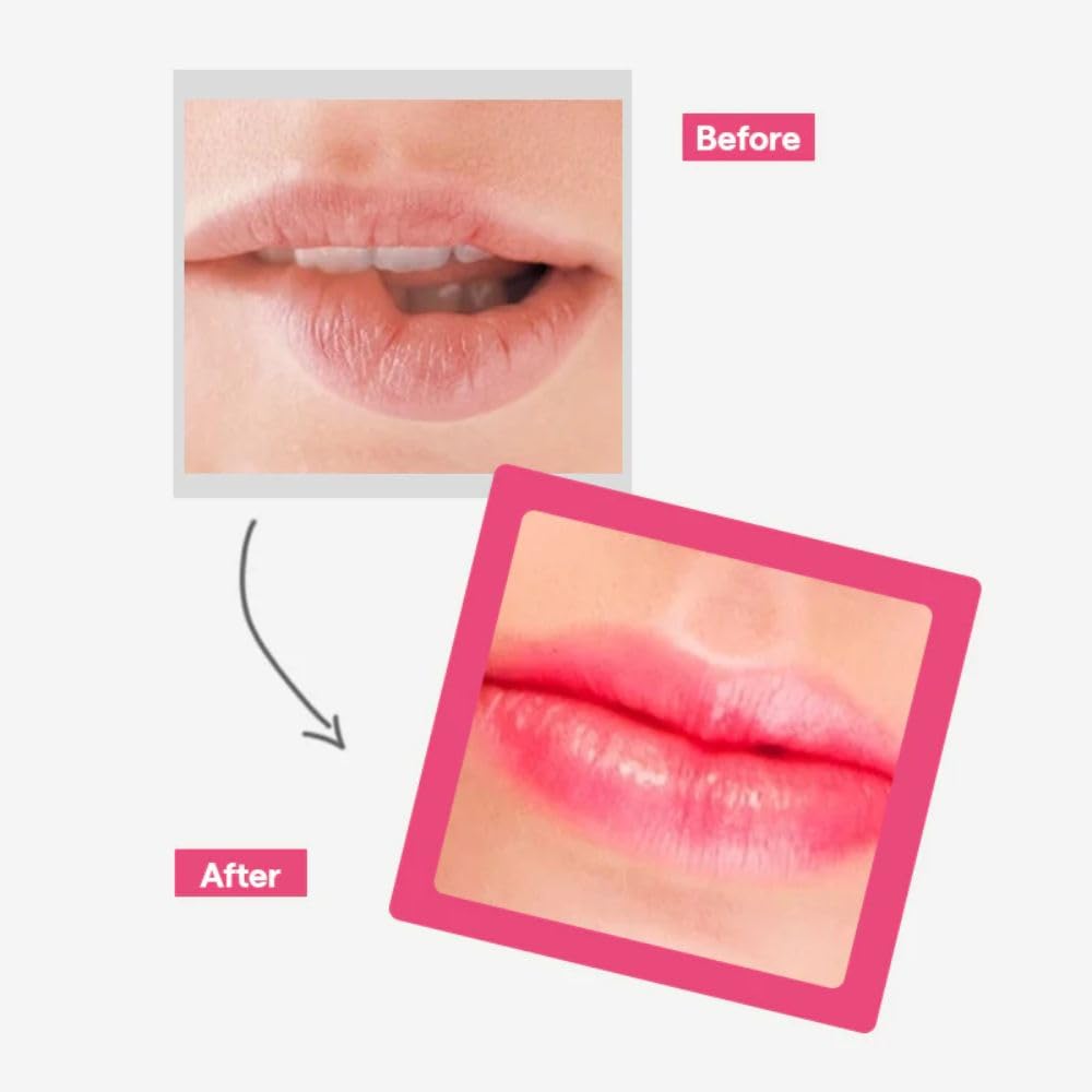 MEDIHEAL Pantenolips Healssence Berry Pink LipEssence (10 ml) Hydrating Korean Treatment with Panthenol, Berry Extracts & Vitamin E for Dry Chapped Lips with Natural Pink Tint, Intensive Lip Care