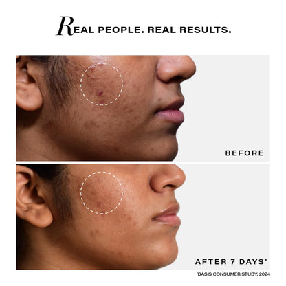 Before and after comparison of a skin treatment on a person's face with text 'Real People. Real Results.'