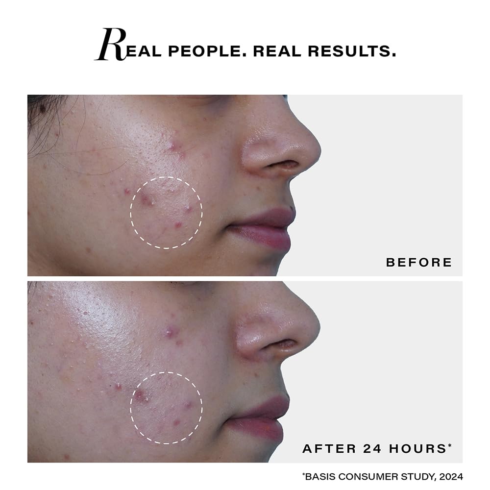 Before and after comparison of skin with acne, showing a clear improvement after 24 hours.