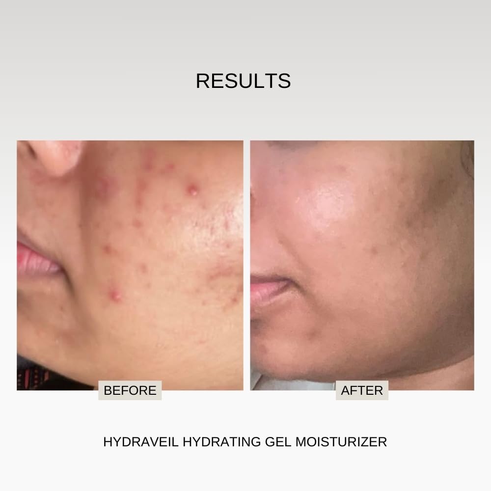 The Formularx Hydra Veil Barrier Care Gel Moisturizer with Ceramide, Hyaluronic Acid, & Ectoin for Oily, Acne & Fungal Acne Prone Skin | Oil Free, Non-comedogenic, Sensitive Skin Friendly | For Women & Men | 50g