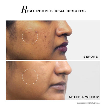 Before and after comparison of a skin treatment on a person's face with text 'Real People. Real Results.'