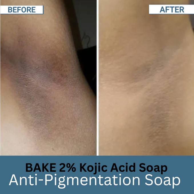 BAKE 2% Kojic Acid Scrub Treatment Soap (200 Gms) for Pigmentation, Dark Spots, Tan Removal, Brightens Underarms | With Alpha Arbutin, Lactic Acid & Niacinamide | Soap for Women & Men | 100g x 2
