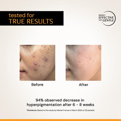 Before and after comparison of skin with hyperpigmentation on a beige background.
