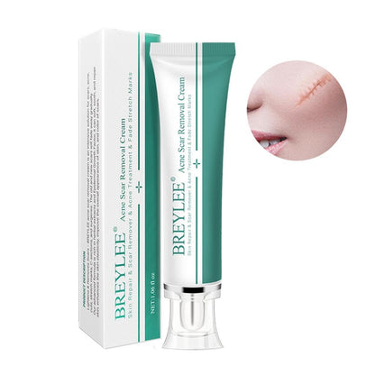 CLUB BOLLYWOOD® Removal Scar Cream Face Pimples Scar Stretch Marks Removal Acne Treatment | Bath & Body | Scar & Stretch Mark Reducers