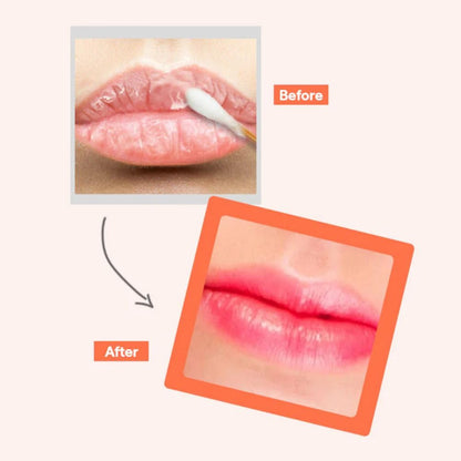 MEDIHEAL Pantenolips Healssence (10 ml, Coral) Hydrating Korean Treatment for lips with Panthenol & Shea Butter for Dry Chapped Lips, Moisturizing Nourishing lip Treatment, Glossy Lip Care