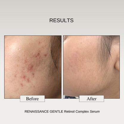 The Formularx 0.1% Retinol + 0.5% Granactive Retinol Gentle Complex Serum With Niacinamide & Bakuchiol | For Acne, Acne Marks, Dark Spots, Wrinkles, & Pores | Anti Aging & Brightening Face Serum | 30G