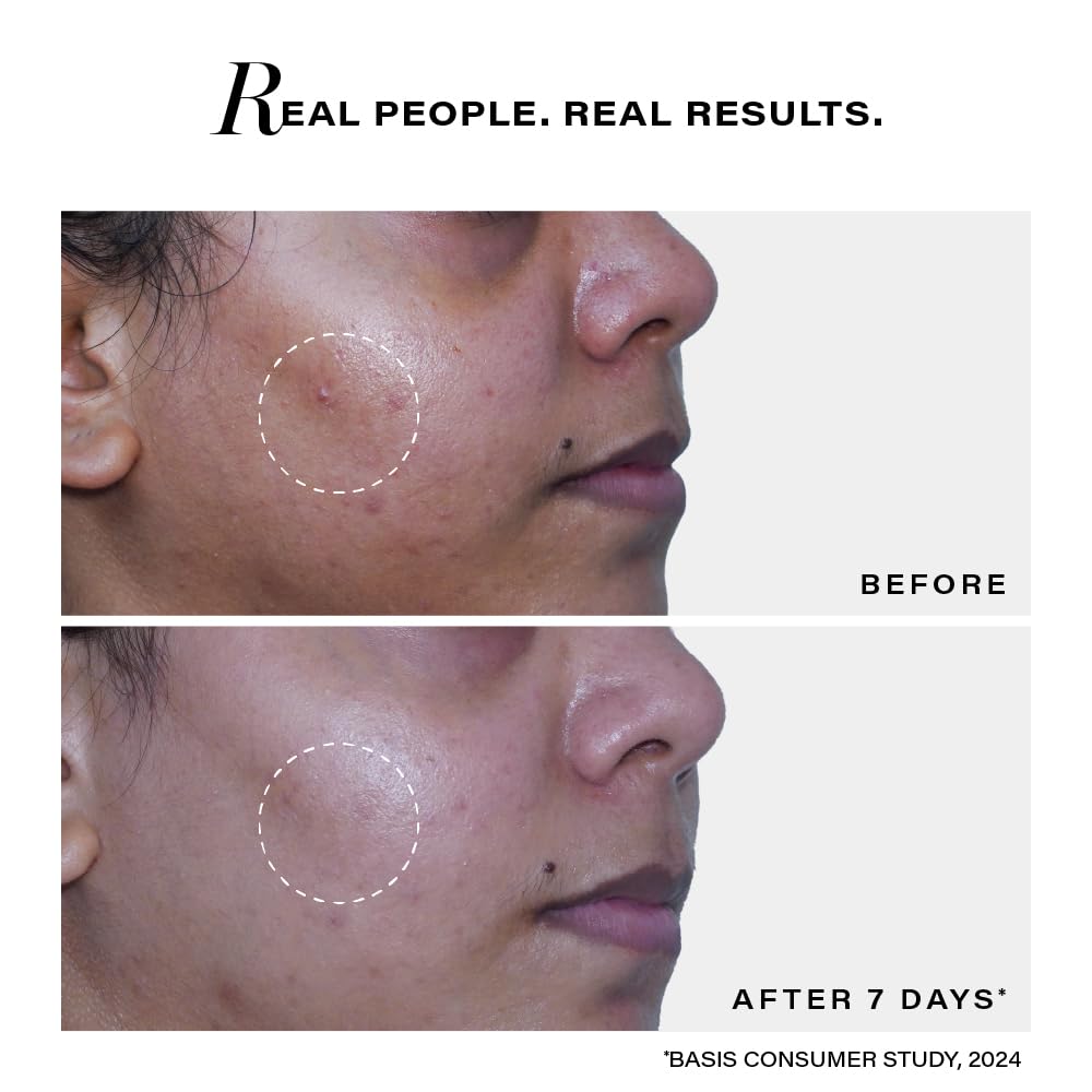 Before and after comparison of a skin treatment on a person's face with text 'Real People. Real Results.'