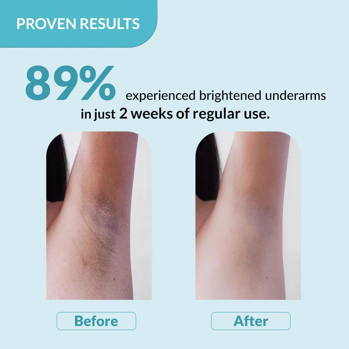 Before and after comparison of underarm hair reduction with text indicating 89% success rate.