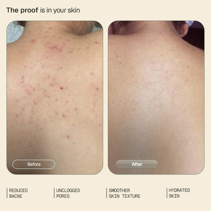 Arata 1% Salicylic Body Wash for Bacne & Dry Skin | 92% Reduction in Body Acne Causing Bacteria | Exfoliating Shower Gel for Rough & Uneven Skin | Scientifically Proven & Derma Tested | 250 ml