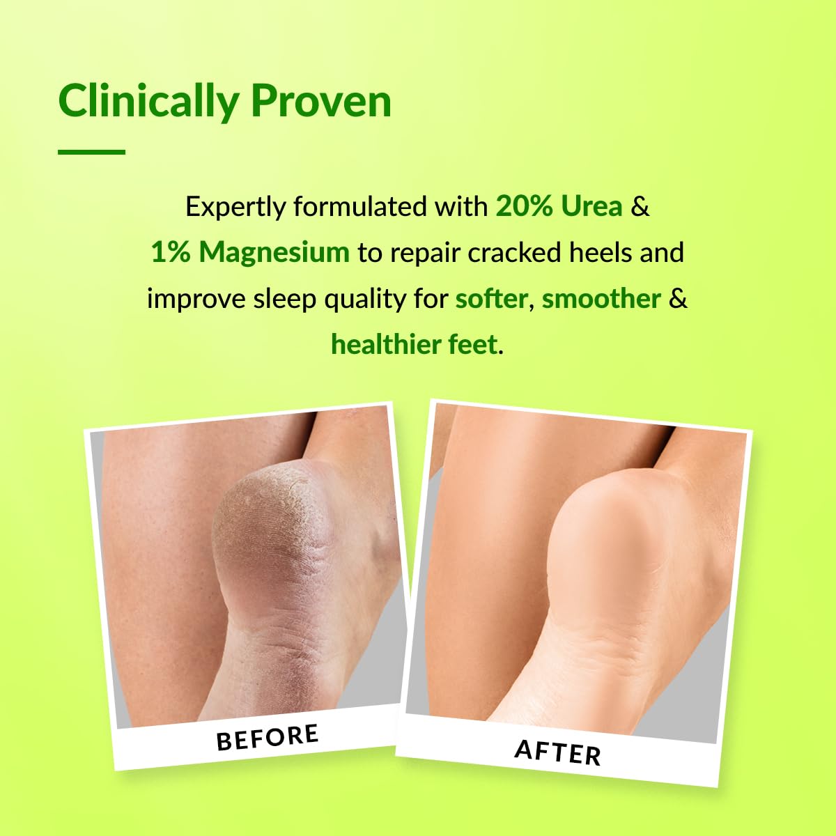 Fixderma Foobetik 20% Urea Foot Roll On For Dry & Cracked Heels with 5% Lactic Acid & 1% Magnesium | Dermatologically Tested | Helps Repair and Moisturise Cracked Heels - 60ml