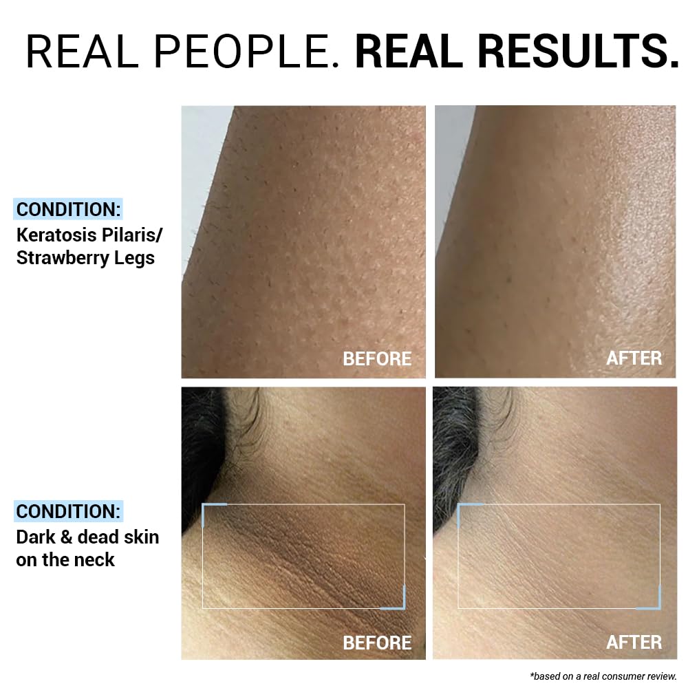 Before and after comparison of Keratosis Pilaris and dark skin on neck with text 'Real People. Real Results.'