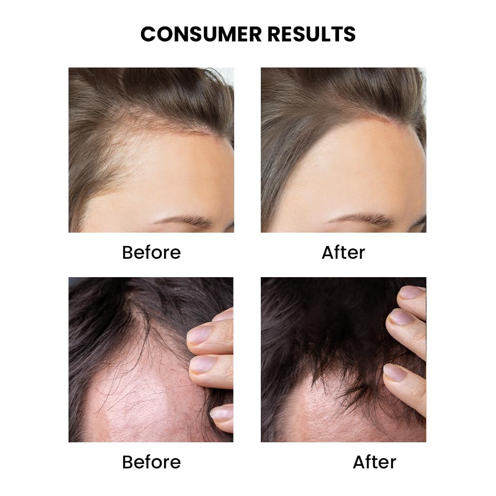 Before and after hair growth comparison on a person's head.