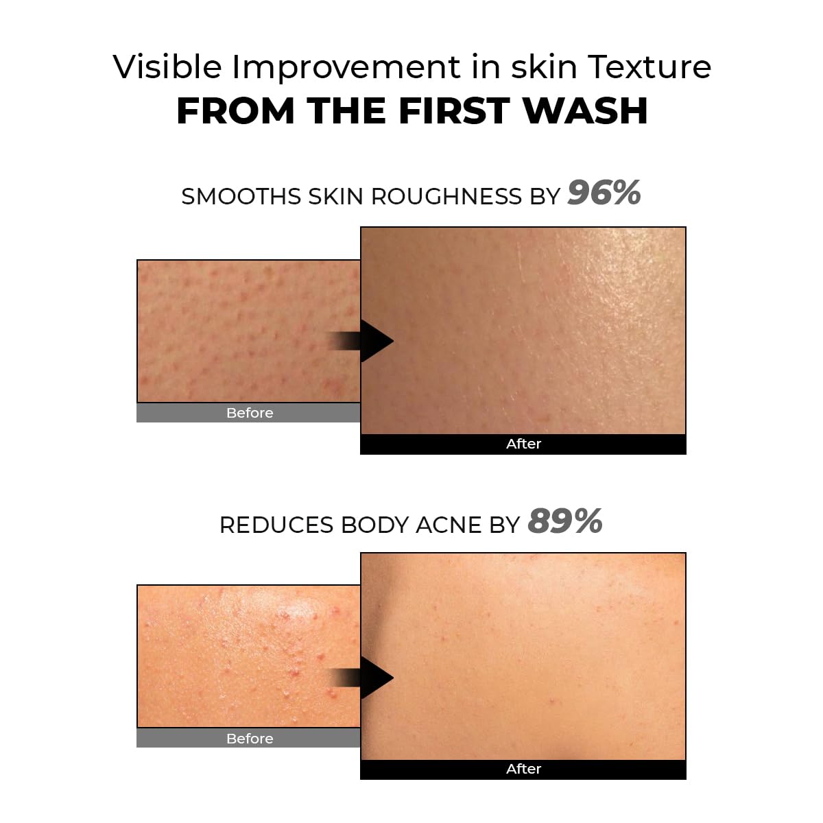 Before and after effects of a skincare product on skin texture and acne reduction.