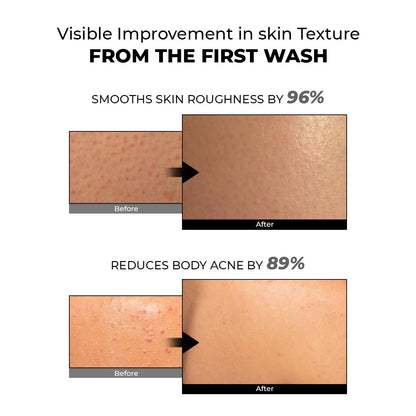 Before and after effects of a skincare product on skin texture and acne reduction.