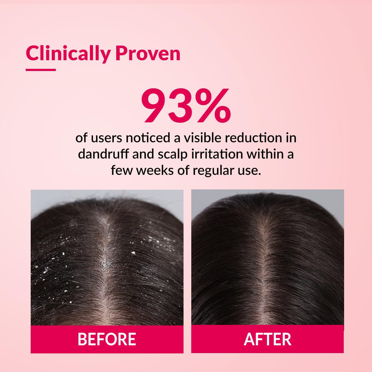 Fixderma Bioteez-S, Anti Dandruff Shampoo, Flaky Scalp Condition, Nourish Dry Hair, Relieves Itchy & Dry Scalp, Recurrent Dandruff, Sulphate & Paraben Free Formulation - 75ml