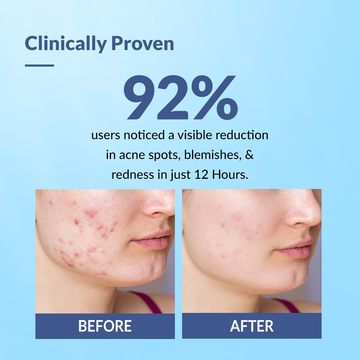 Fixderma Salyzap 2% Salicylic Acid Acne Spot Corrector Gel with 2% Niacinamide Acid & 1% Aczero | Reduce Active Acne & Redness | Fades Dark Spots & Blemishes | Pimple Remover For Men & Women - 20g
