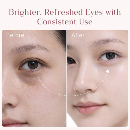 Seoulskin under eye cream | dark circles removal for women and men | Under Eye Gel to Reduce Dark Circles, Puffiness & Wrinkles With Built-in Cooling Massage Roll-On Applicator | 5% Niacinamide, 2% Alpha Arbutin | 15 ml