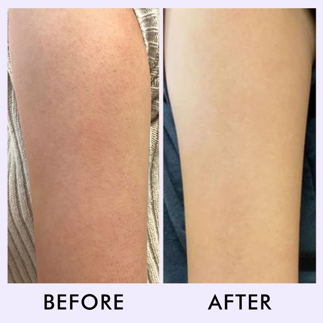 Before and after comparison of a person's leg with visible skin texture on the left and smooth skin on the right.