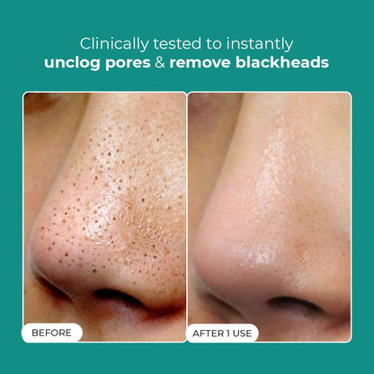 Before and after comparison of a nose with blackheads on a teal background