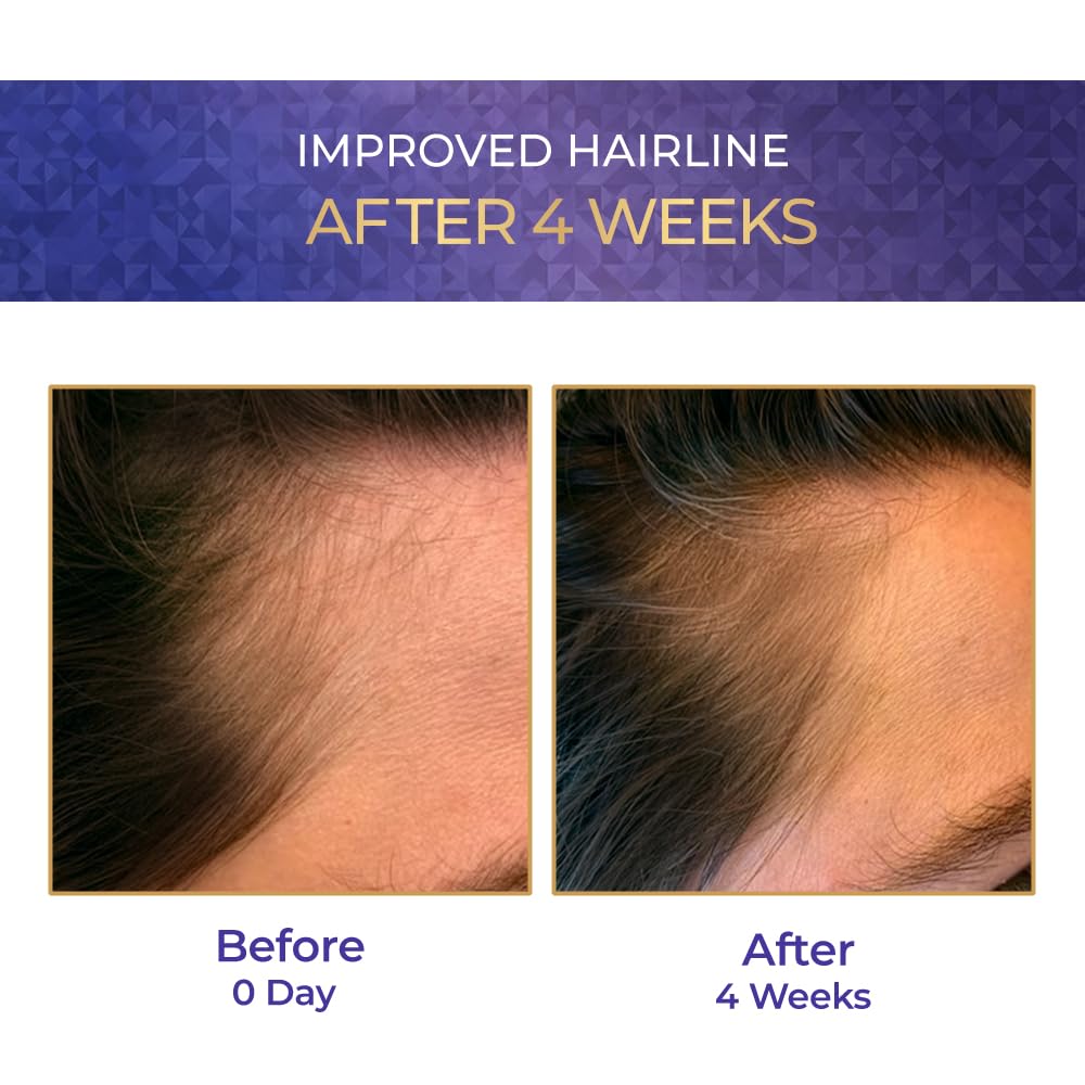Before and after comparison of a hairline improvement after 4 weeks with a purple banner at the top.