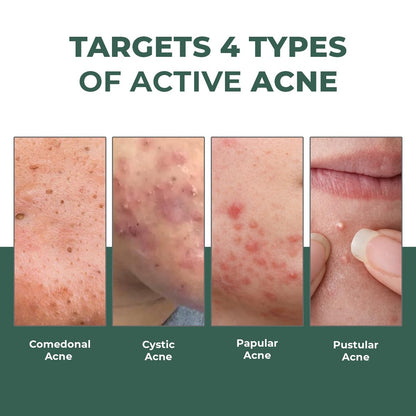 Acne types on skin with text 'Targets 4 Types of Active Acne' on a green background