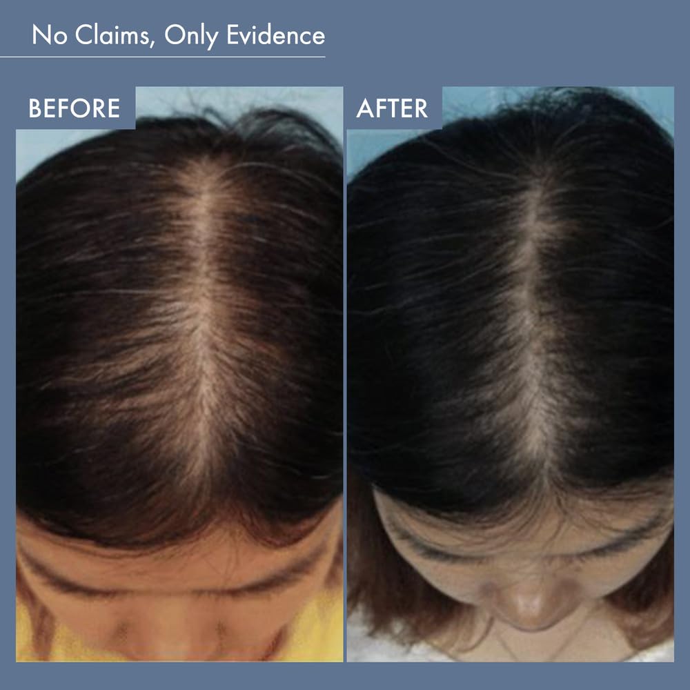 Before and after comparison of hair thickness on a person's head.