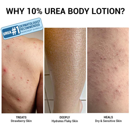 Sereko 10% Urea & Avocado Oil Body Lotion 200ML | For Strawberry legs, Detans, Rough Bumpy skin| Body lotion for Men & Women | AHA BHA free | Gentle Exfoliating | with 48H Moisturization | Very dry, flaky skin