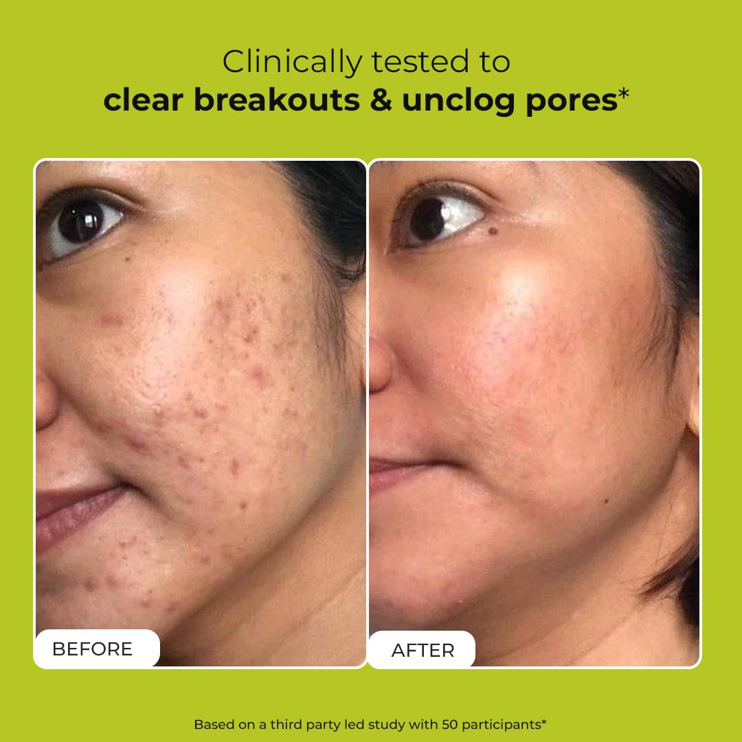 Before and after comparison of a person's face with acne on a green background