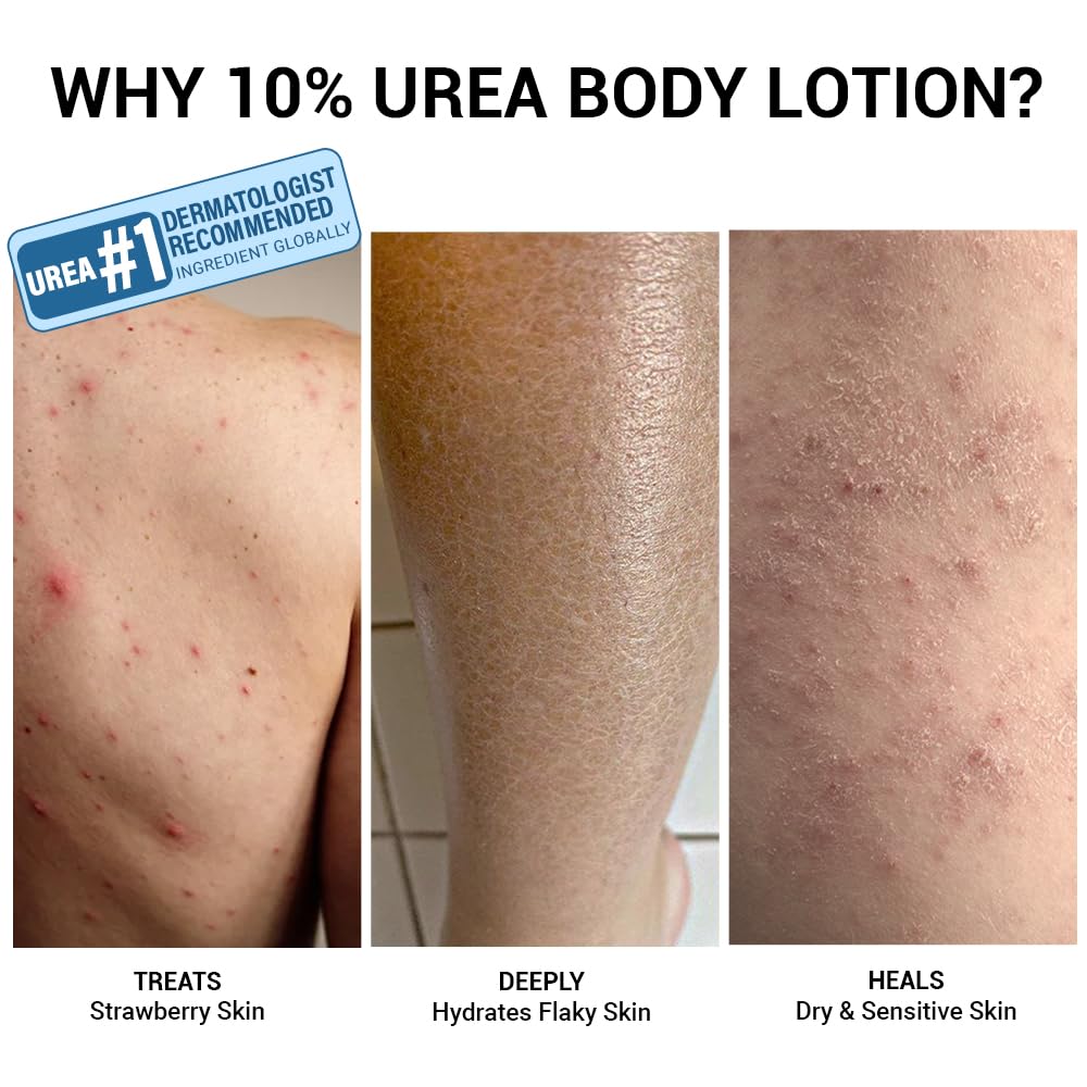 Comparison of skin conditions treated with 10% urea body lotion on a tiled floor.