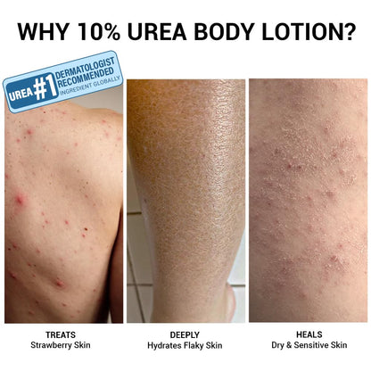 Comparison of skin conditions treated with 10% urea body lotion on a tiled floor.