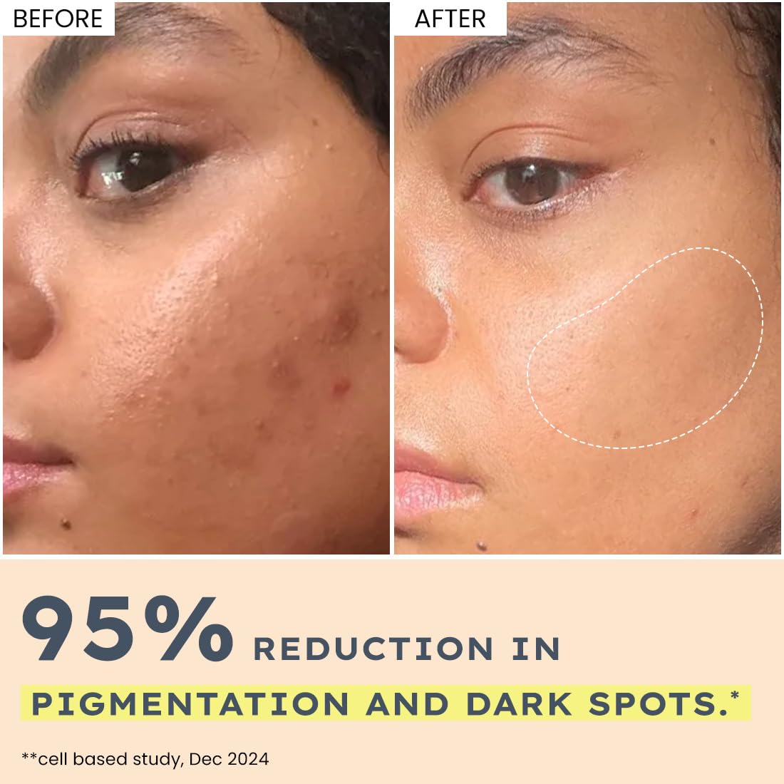 Before and after comparison of skin with 95% reduction in pigmentation and dark spots.