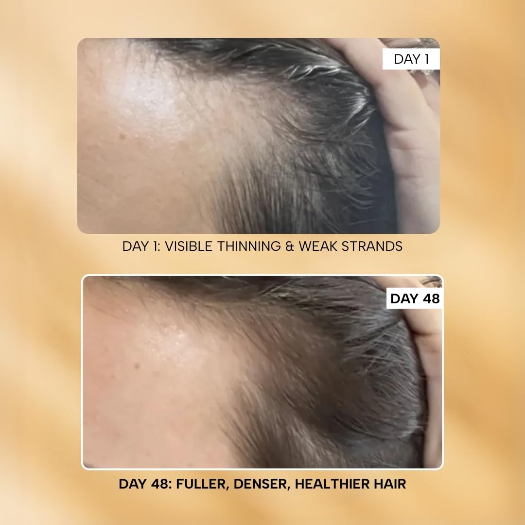 RAS Root-ine™ Hair Growth Serum with 19.5% Scalp Actives | Redensyl & Anagain | Promotes Hair Growth, Stimulates Hair Follicles & Regrowth | Controls Hair Fall & Increases Hair Density | Hair Growth Serum for Women & Men