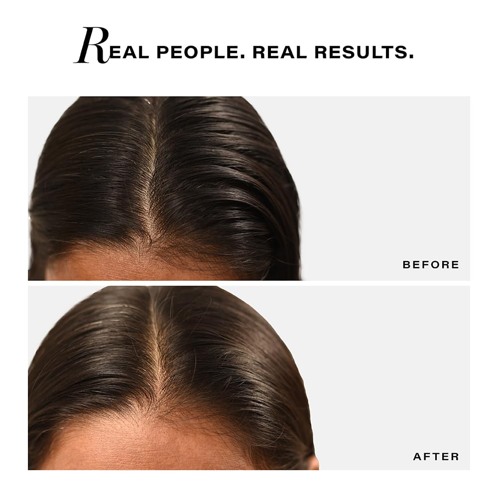 Before and after comparison of hair treatment on a person's head with text 'Real People. Real Results.'