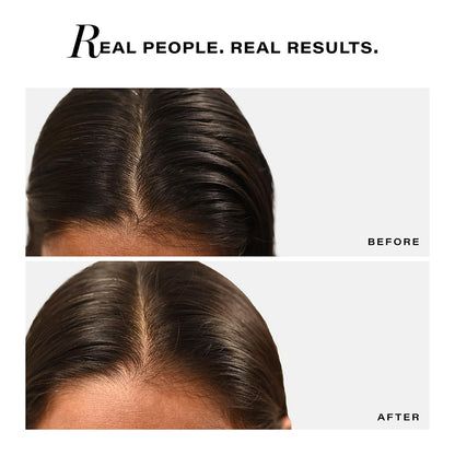 Before and after comparison of hair treatment on a person's head with text 'Real People. Real Results.'