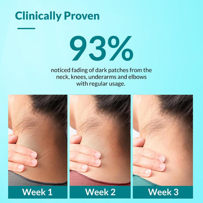Fixderma Nigrifix Cream for Acanthosis Nigricans with Lactic Acid | Dermatologist Tested Retinol Cream | For Dark Body Parts like Neck, Ankles, Knuckles, Armpits, Thighs & Elbows | Exfoliant - 50g