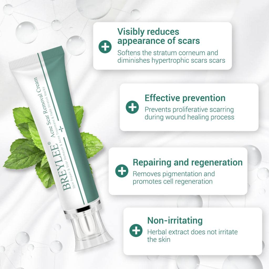 CLUB BOLLYWOOD® Removal Scar Cream Face Pimples Scar Stretch Marks Removal Acne Treatment | Bath & Body | Scar & Stretch Mark Reducers